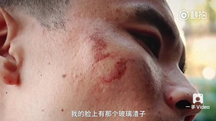 iPhone 7中国首爆？男子被炸到手掌开花