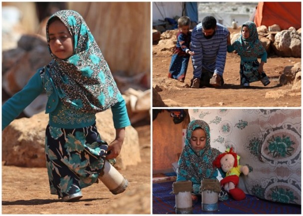 心酸！叙利亚无腿女童用鱼罐头当义肢