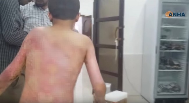 土耳其打库德族疑用化武 叙利亚孩童遭白磷灼伤