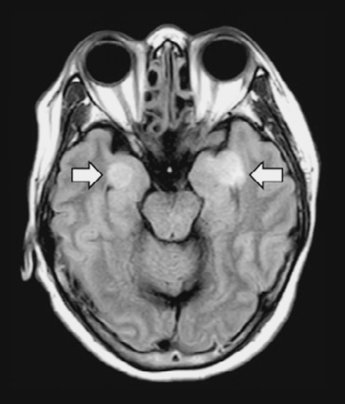 ma_0424_NF_Pathology_brainscan.jpg