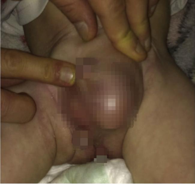 全球首例 伊拉克男婴天生有3根阴茎
