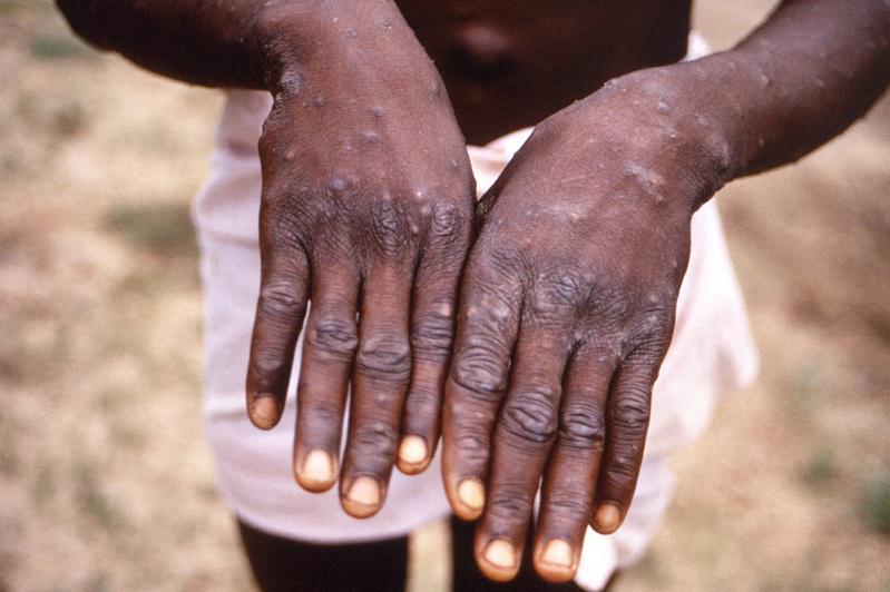 CDC公布1996年到1997年時，非洲剛果共和國暴發的猴痘疫情，患者雙手出現疹...