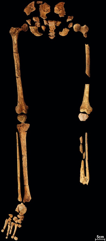 地球上最早的截肢手术 3万年前化石改写医疗史