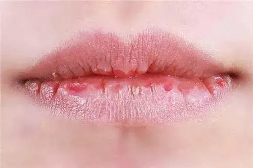 让你远离撕裂的痛——8个天然护唇法
