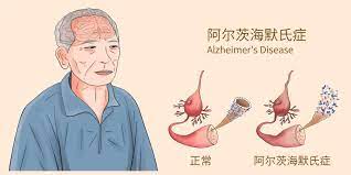 阿尔兹海默病存在至少5种亚型 或可精准治疗