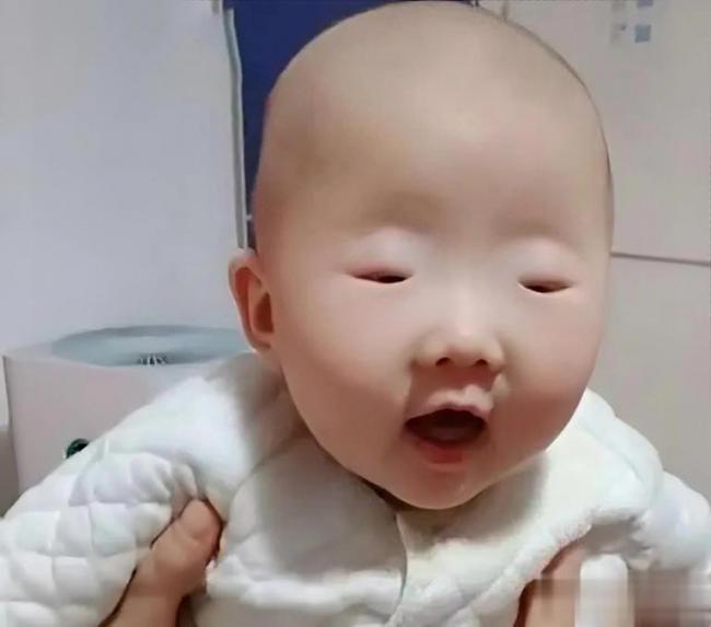 娃出生“没眼睛”  父母急要哭   医生却笑了