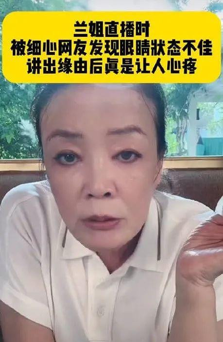 66岁张兰不幸发病 确诊白癜风影响容貌 66岁张兰不幸发病 确诊白癜风影响容貌