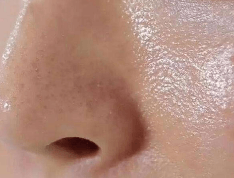 皮肤出油严重 脸颊又干到起皮怎么回事? 皮肤出油严重 脸颊又干到起皮怎么回事?