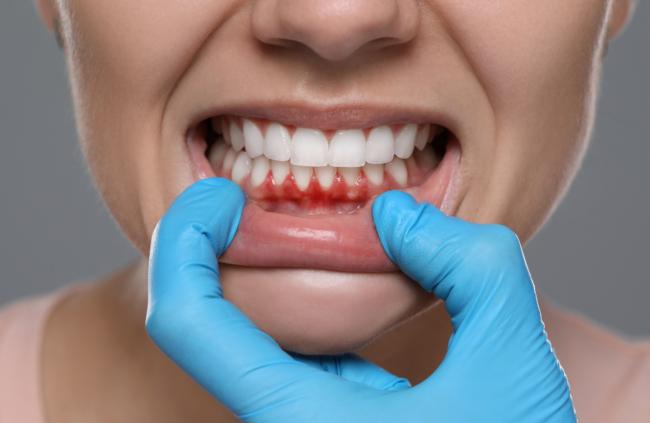 健康的牙龈对身体健康至关重要 健康的牙龈对身体健康至关重要