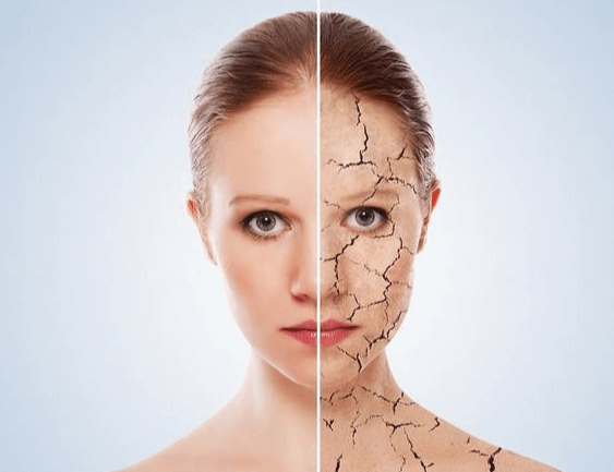 干皮护肤:补水还是补油? 干皮护肤:补水还是补油?