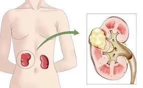不痛不痒查出癌?警惕无症状突袭 不痛不痒查出癌?警惕无症状突袭