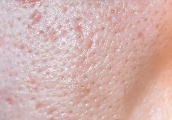 毛孔粗大+多油皮肤:如何从根源改善皮肤问题 毛孔粗大+多油皮肤:如何从根源改善皮肤问题