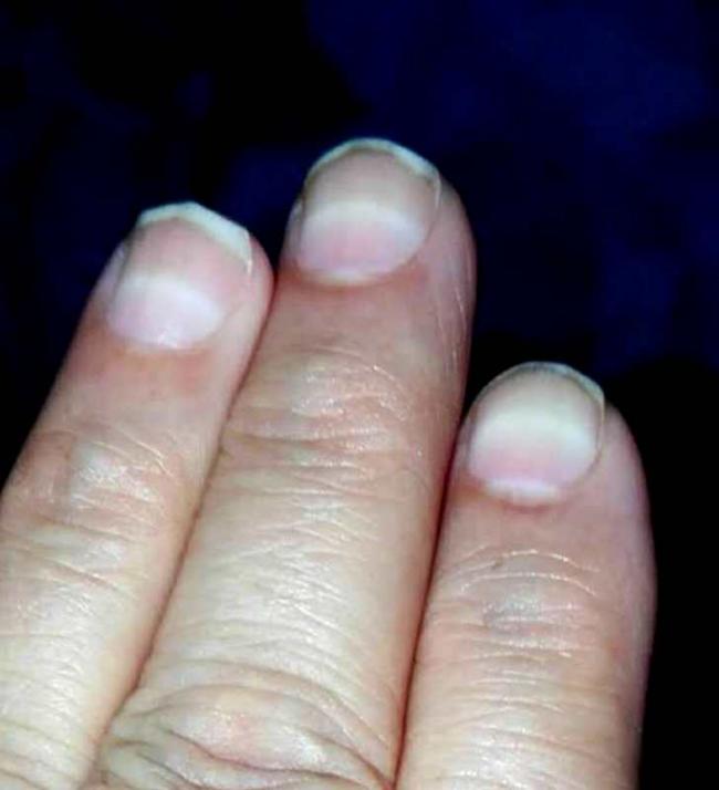 湖南3岁女童大把脱发 竟是急性铊中毒