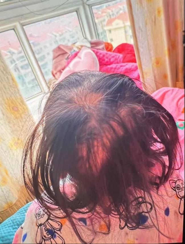 湖南3岁女童大把脱发 竟是急性铊中毒