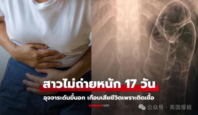 台湾女便秘竟憋到“吐翔” X光显示塞满胸腔