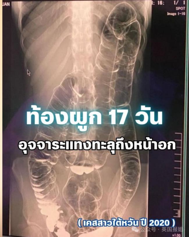 台湾女便秘竟憋到“吐翔” X光显示塞满胸腔