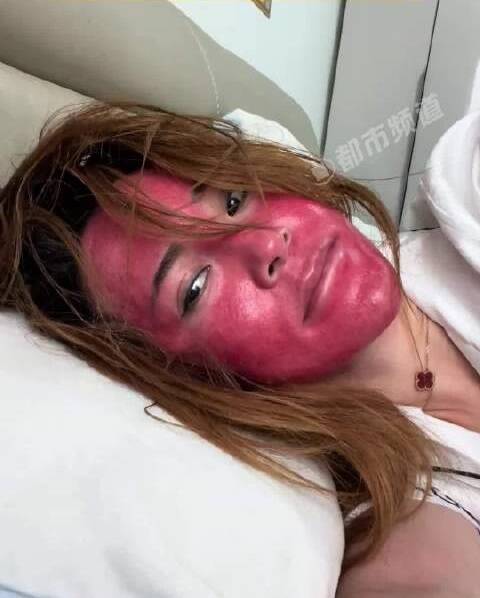 不卸妆22年？中国女变“关公” 脸部红肿硬如壳