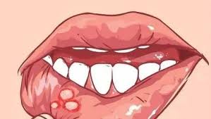 46岁男子口腔溃疡20年 拖出一身血栓 46岁男子口腔溃疡20年 拖出一身血栓