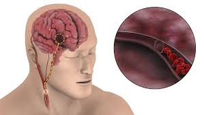 睡觉出现这5种异常 要警惕脑卒中 睡觉出现这5种异常 要警惕脑卒中