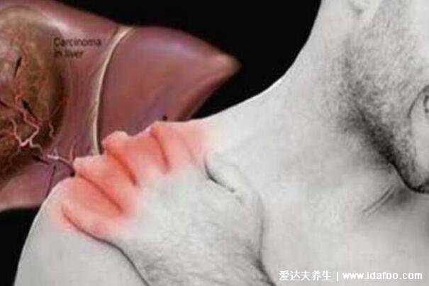 三个症状说明有肝癌了 三个症状说明有肝癌了
