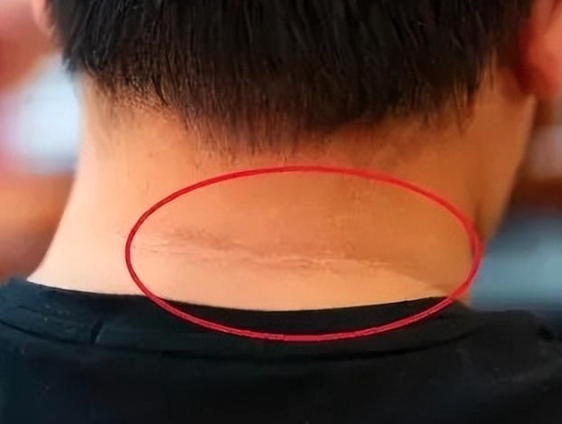 注意：皮肤这6种变化，可能是“癌症”信号