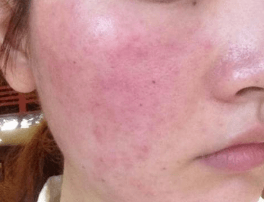 秋风起,脸泛红?揭秘秋季皮肤敏感加剧的真相 秋风起,脸泛红?揭秘秋季皮肤敏感加剧的真相