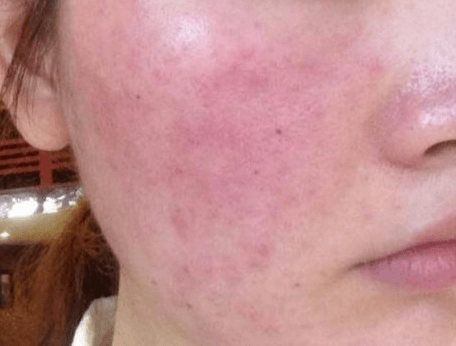 脸部皮肤过敏立即执行的“急救三步曲” 脸部皮肤过敏立即执行的“急救三步曲”