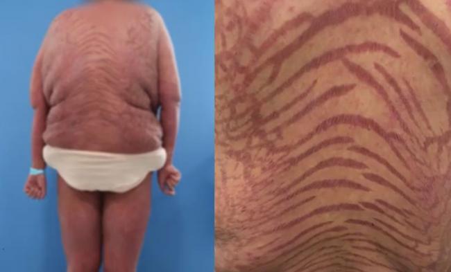 包治百病神药害她成“蛇皮人”!医揭恐怖成分 包治百病神药害她成“蛇皮人”!医揭恐怖成分