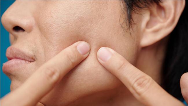 浙江男大生挤暗疮 鬼门关前走一圈