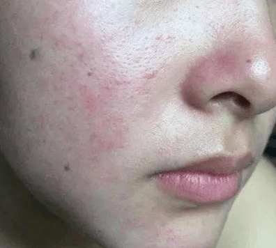 脸反复过敏+屏障受损?别乱涂药膏 脸反复过敏+屏障受损?别乱涂药膏