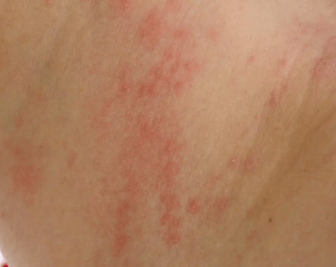 皮肤过敏不是莫名来的 3大核心原因帮你找准根源 皮肤过敏不是莫名来的 3大核心原因帮你找准根源