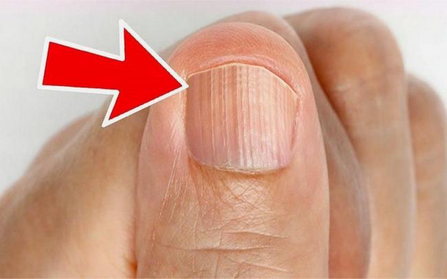 指甲长竖纹是健康“警报”?看有没有这4个特征 指甲长竖纹是健康“警报”?看有没有这4个特征