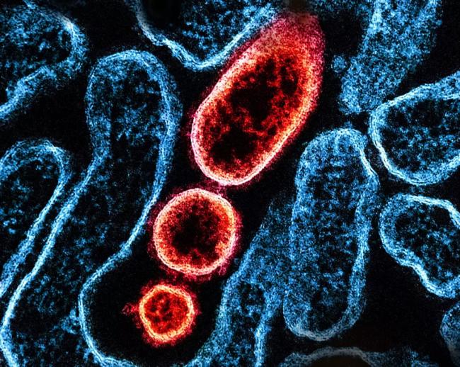 尼帕病毒会成全球大流行吗 专家谈关键一点