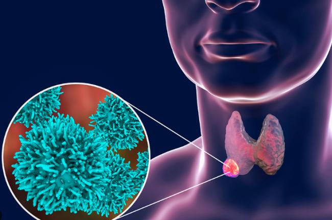 注意：这6个因素竟是甲状腺癌催化剂