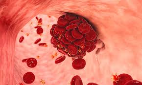 身体出现6个异常 多半是血栓“堵牢了”!别耽误 身体出现6个异常 多半是血栓“堵牢了”!别耽误