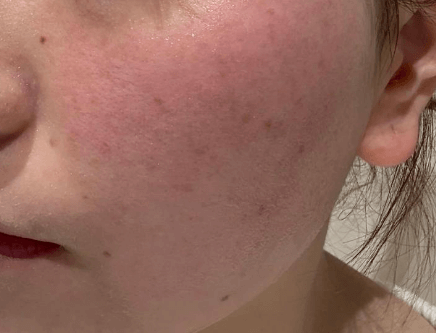 冬季敏感肌8大注意事项 安稳度过干燥季 冬季敏感肌8大注意事项 安稳度过干燥季