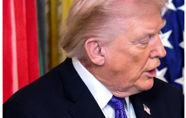 川普右颈现大片皮疹 再惹健康疑云 川普右颈现大片皮疹 再惹健康疑云