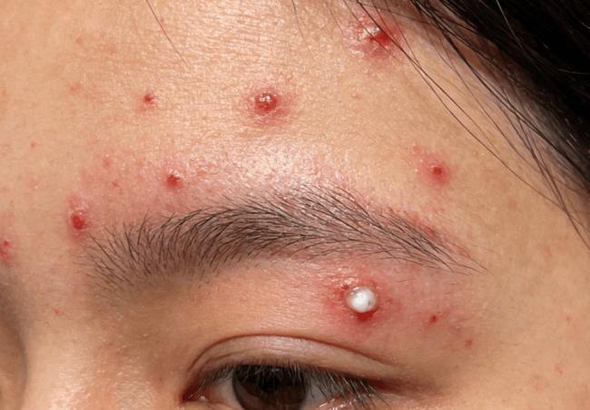 长痘、暗沉、口气:肠道排毒与肌肤的深层关联 长痘、暗沉、口气:肠道排毒与肌肤的深层关联