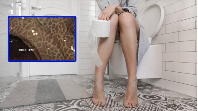 西安女十年来靠通便茶 惊现恐怖“豹纹”肠 西安女十年来靠通便茶 惊现恐怖“豹纹”肠