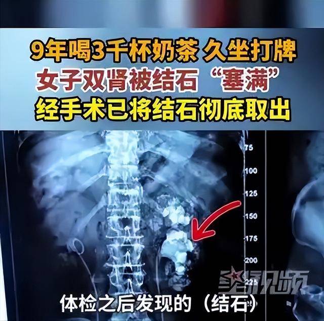 长沙女子9年狂喝3000杯奶茶,悲剧发生了 长沙女子9年狂喝3000杯奶茶,悲剧发生了