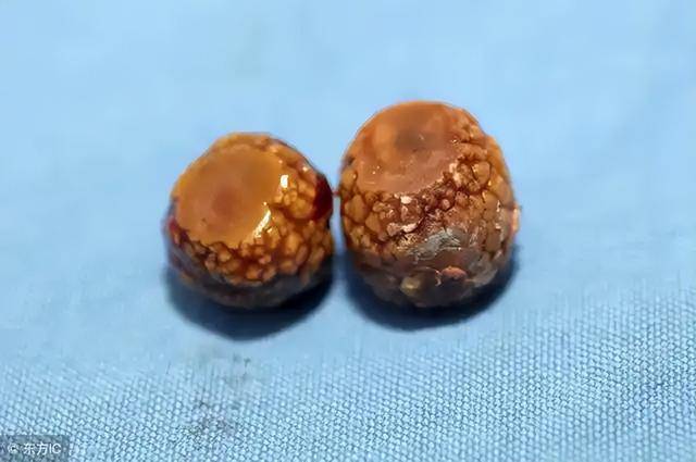 长沙女子9年狂喝3000杯奶茶,悲剧发生了 长沙女子9年狂喝3000杯奶茶,悲剧发生了