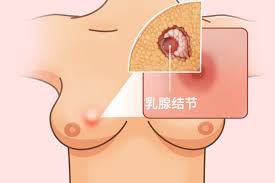 乳腺结节会变成癌吗?医生:这3种情况要注意 乳腺结节会变成癌吗?医生:这3种情况要注意