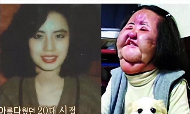 女星整容下狠手 头部取出一公斤液体物质