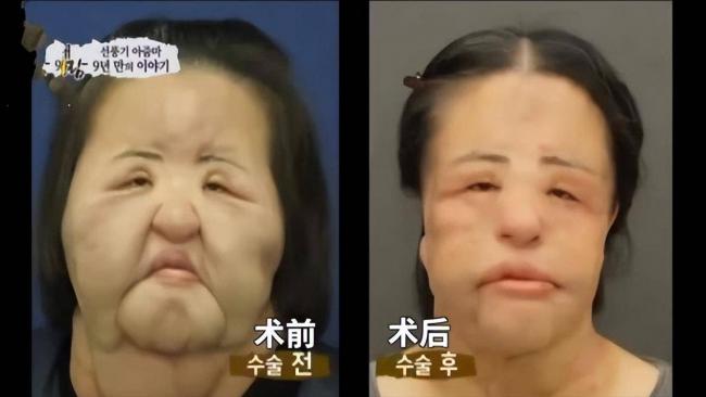 女星整容下狠手 头部取出一公斤液体物质