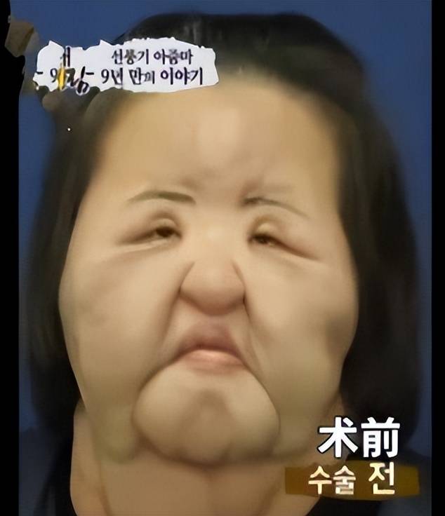 女星整容下狠手 头部取出一公斤液体物质