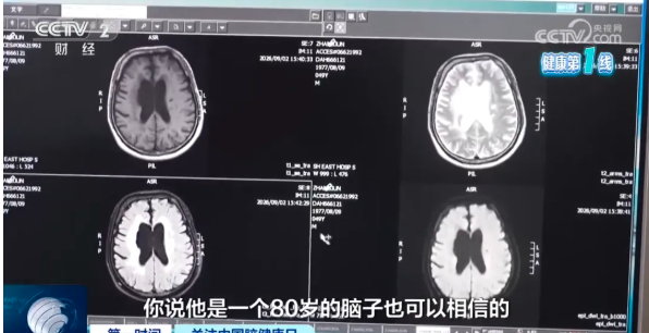 49岁男大脑萎缩如80岁 六大伤脑行为你每天在做 49岁男大脑萎缩如80岁 六大伤脑行为你每天在做