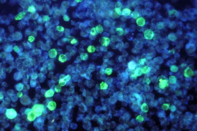 全球12%癌症与感染有关 这种细菌竟藏华人饭桌上 全球12%癌症与感染有关 这种细菌竟藏华人饭桌上